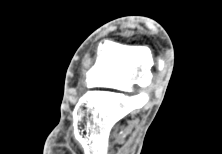 File:Advanced osteomyelitis due to open metatarsal fracture (Radiopaedia 83891-99095 Axial non-contrast 8).jpg