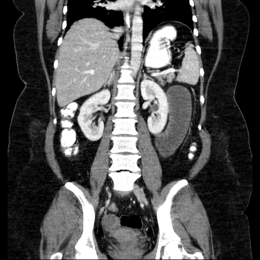 File:Afferent loop syndrome - secondary to incarcerated trocar site hernia (Radiopaedia 82959-97305 Coronal C+ portal venous phase 96).jpg