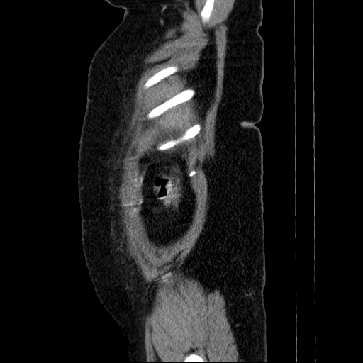 File:Afferent loop syndrome - secondary to incarcerated trocar site hernia (Radiopaedia 82959-97305 Sagittal C+ portal venous phase 143).jpg