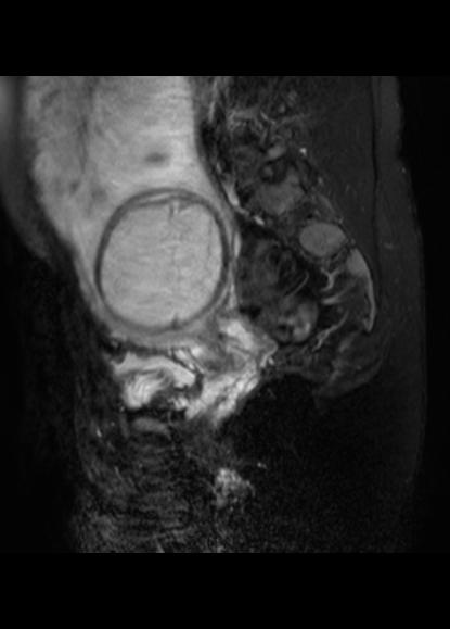 File:Aggressive angiomyxoma of the pelvis and perineum (Radiopaedia 59162-66479 Sagittal T2 fat sat 17).jpg