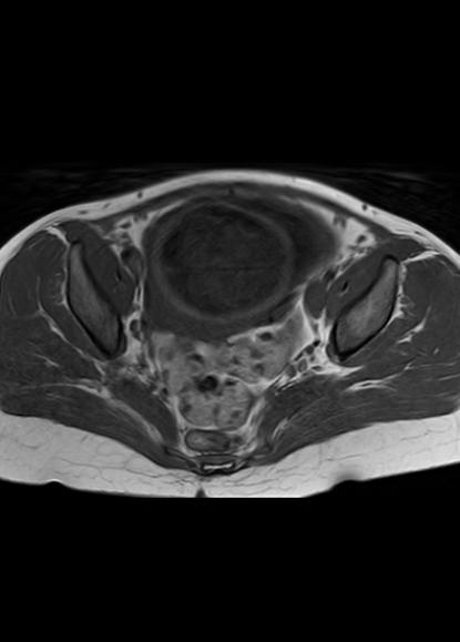 File:Aggressive angiomyxoma of the pelvis and perineum (Radiopaedia 59162-66479 T1 16).jpg