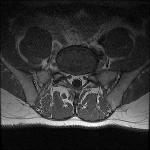 File:Aggressive vertebral hemangioma with pathological fracture (Radiopaedia 69528-79411 Axial T1 C+ 1).jpg