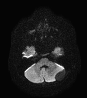 File:Aicardi syndrome (Radiopaedia 66029-75205 Axial DWI 5).jpg