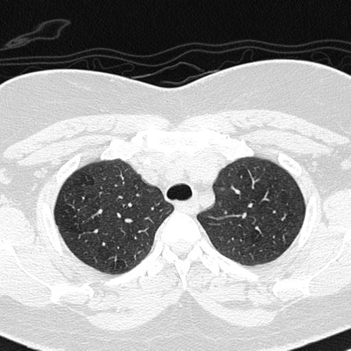 File:Air trapping in small airway disease (Radiopaedia 61685-69694 Axial lung window 35).jpg