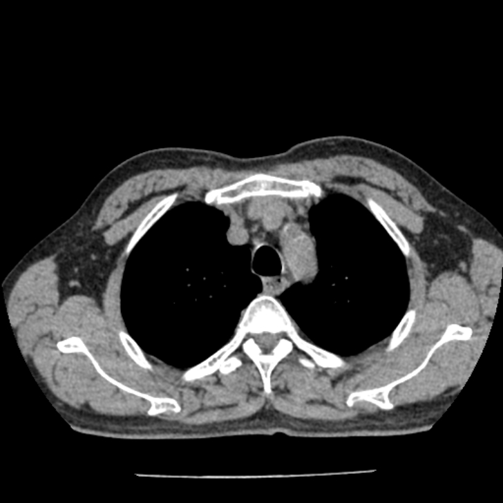 Airway foreign body in adult (Radiopaedia 85907-101779 Axial liver window 24).jpg