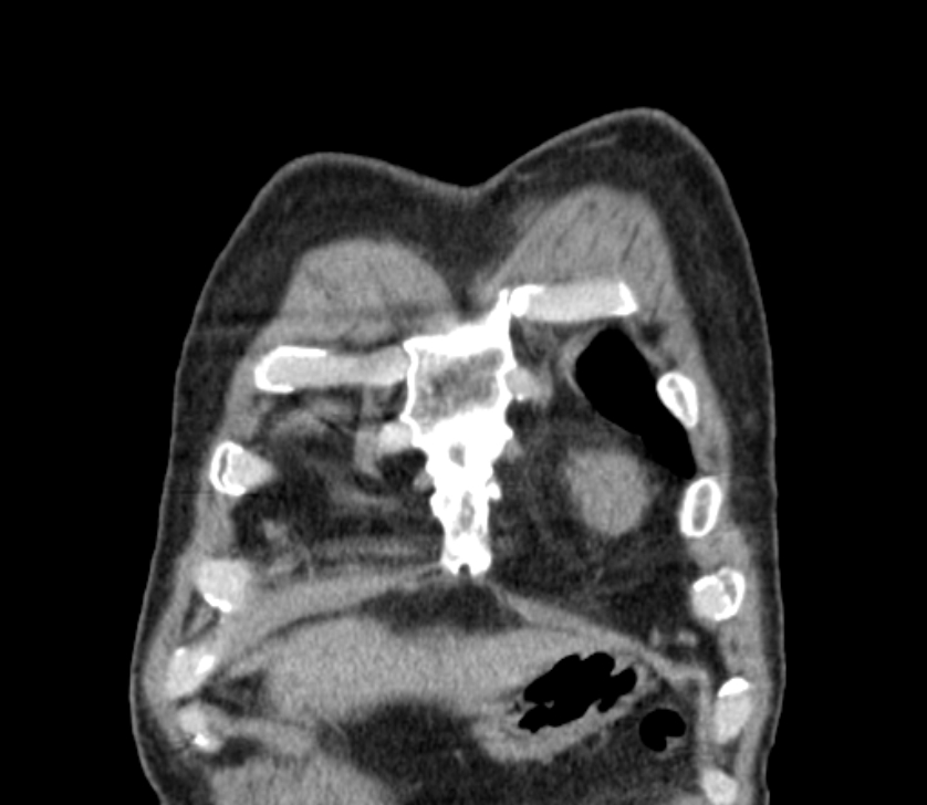 Airway foreign body in adult (Radiopaedia 85907-101779 Coronal liver window 15).jpg