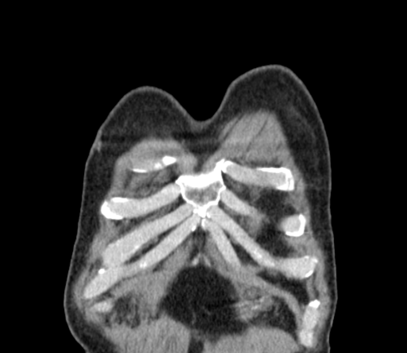 Airway foreign body in adult (Radiopaedia 85907-101779 Coronal liver window 5).jpg