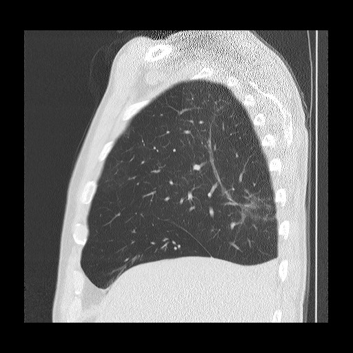 Allergic bronchopulmonary aspergillosis (ABPA) (Radiopaedia 60594-68313 Sagittal lung window 46).jpg