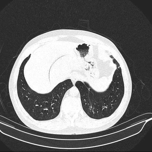 File:Allergic bronchopulmonary aspergillosis (Radiopaedia 21386-21320 Axial lung window 34).jpg