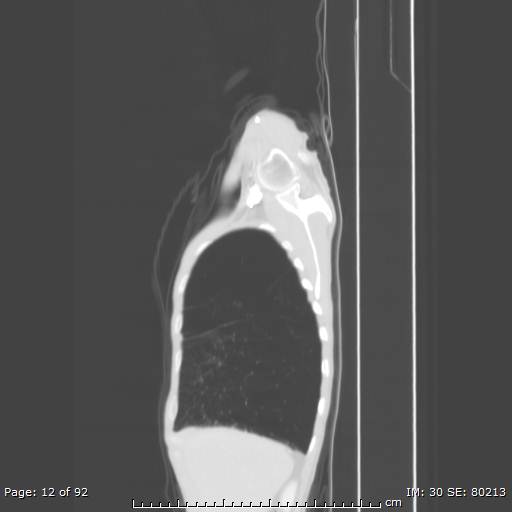 File:Alpha-1-antitrypsin deficiency (Radiopaedia 50561-55987 Sagittal lung window 6).jpg
