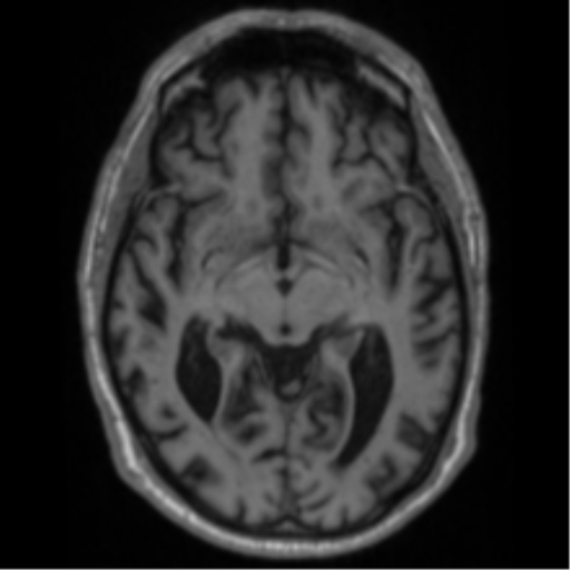 File:Alzheimer's disease- with Gerstmann syndrome and dressing apraxia (Radiopaedia 54882-61150 Axial T1 33).png