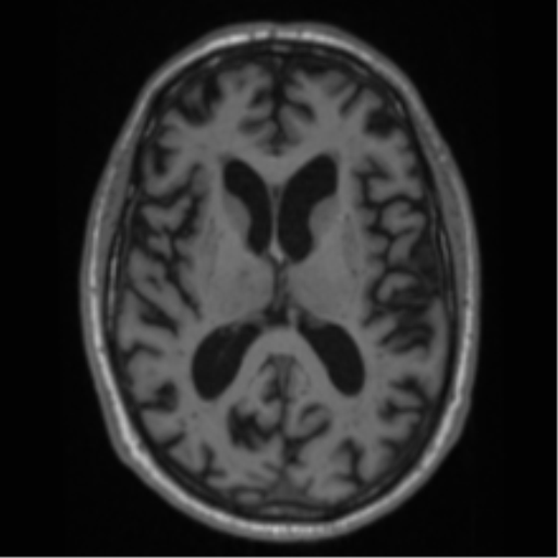 Alzheimer's disease- with Gerstmann syndrome and dressing apraxia (Radiopaedia 54882-61150 Axial T1 41).png