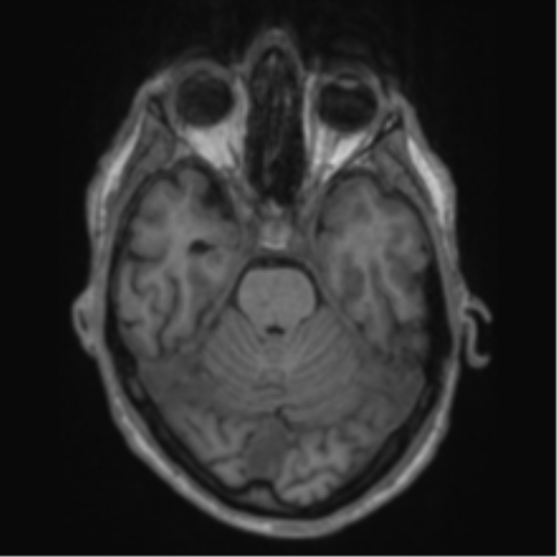 Alzheimer's disease- with apraxia (Radiopaedia 54763-61011 Axial T1 25).png
