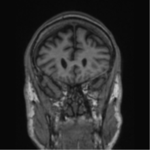 File:Alzheimer's disease- with apraxia (Radiopaedia 54763-61011 Coronal T1 68).png
