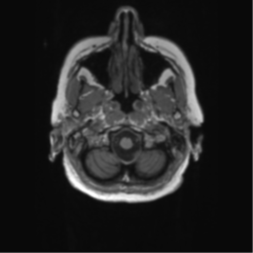 File:Alzheimer's disease (Radiopaedia 42658-45802 Axial T1 137).png