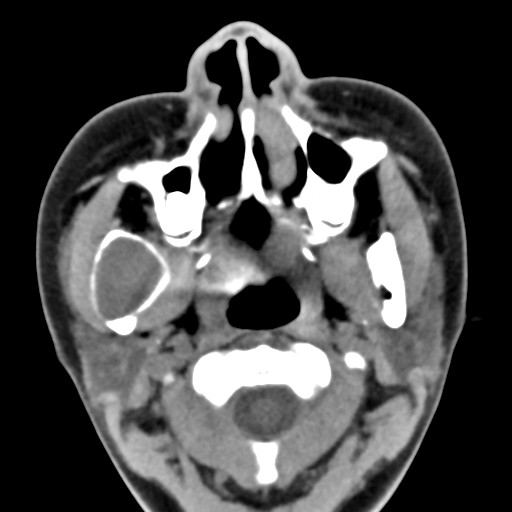 File:Ameloblastoma (Radiopaedia 26645-26793 Axial C+ delayed 26).jpg