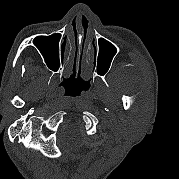Ameloblastoma (Radiopaedia 51921-57766 Axial bone window 124).jpg