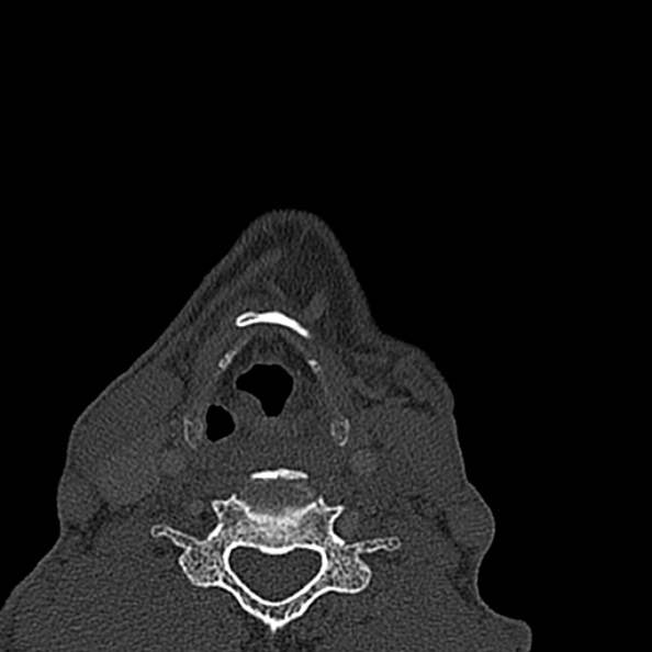 Ameloblastoma (Radiopaedia 51921-57766 Axial bone window 2).jpg