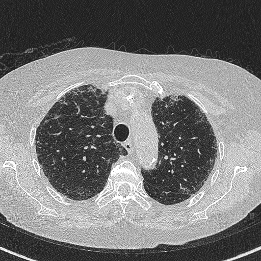 File:Amiodarone-induced pulmonary fibrosis (Radiopaedia 82355-96460 Axial lung window 19).jpg