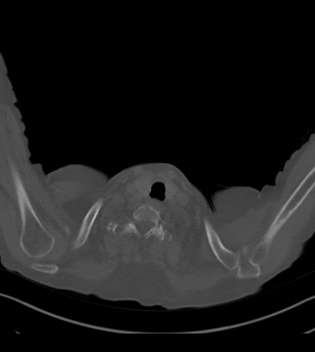 Amiodarone deposition in the liver (Radiopaedia 77587-89780 Axial bone window 1).jpg