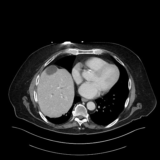 File:Ampullary adenocarcinoma (Radiopaedia 59373-66734 C 17).jpg