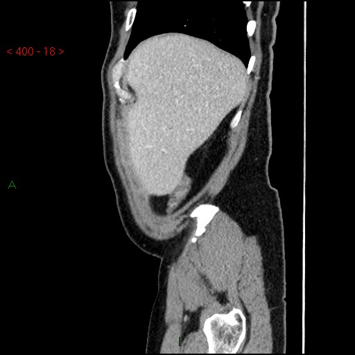 Ampullary carcinoma (Radiopaedia 56396-63056 D 17).jpg