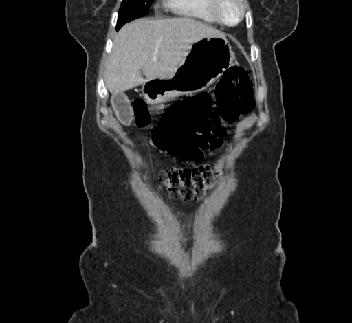 File:Ampullary tumor (Radiopaedia 60333-67998 B 11).jpg