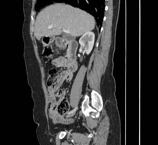 File:Ampullary tumor (Radiopaedia 60333-67998 C 19).jpg