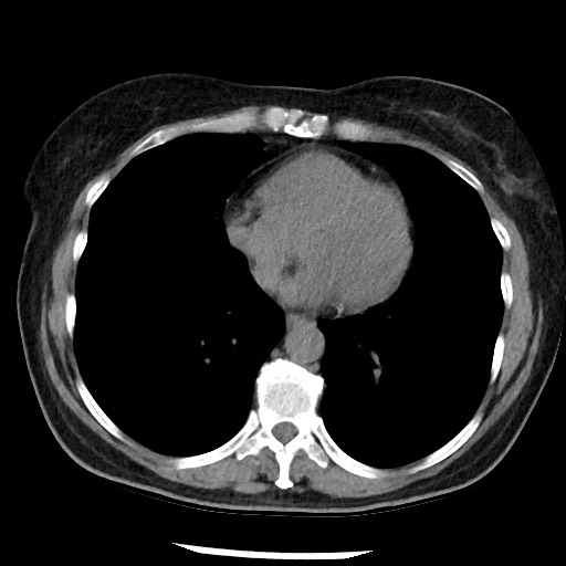 Amyloidosis - bronchial and diffuse nodular pulmonary involvement (Radiopaedia 60156-67744 Axial non-contrast 38).jpg