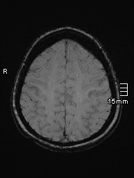 File:Amyotrophic lateral sclerosis (Radiopaedia 70821-81017 Axial SWI 43).jpg