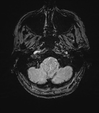 Anaplastic astrocytoma - thalamic glioma (Radiopaedia 59709-67115 G 9).png