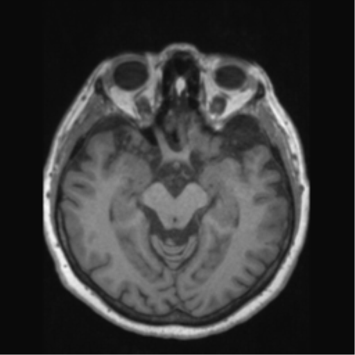 Anaplastic astrocytoma IDH wild-type (pseudoprogression) (Radiopaedia 42209-45276 Axial T1 66).png