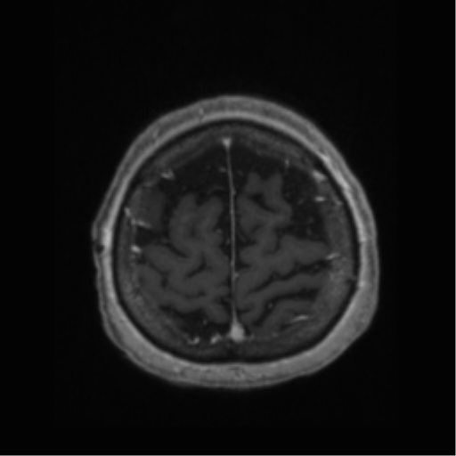 File:Anaplastic astrocytoma IDH wild-type (pseudoprogression) (Radiopaedia 42209-45277 Axial T1 C+ 111).png