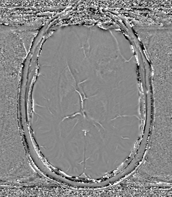 Anaplastic oligodendroglioma (Radiopaedia 83500-98599 Axial SWI - phase 46).png