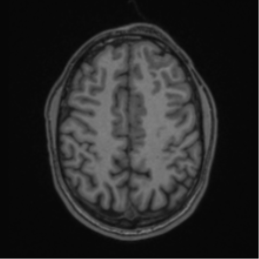Anaplastic oligodendroglioma with skull fracture (Radiopaedia 74831-85845 Axial T1 48).png