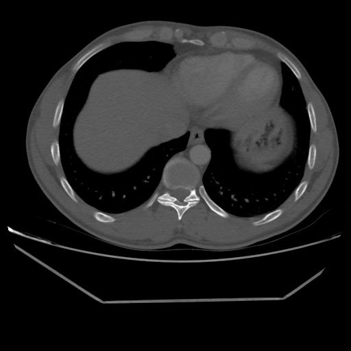 Aneurysmal bone cyst - rib (Radiopaedia 82167-96220 Axial bone window 201).jpg