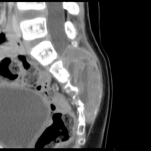 File:Aneurysmal bone cyst - sacrum (Radiopaedia 65190-74195 A 16).jpg