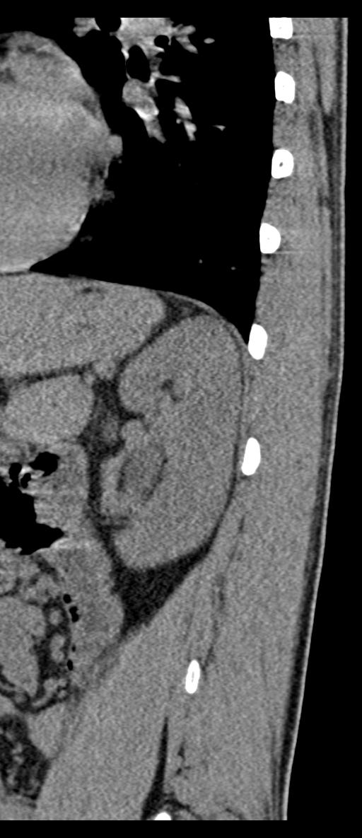 Aneurysmal bone cyst T11 (Radiopaedia 29294-29721 E 7).jpg