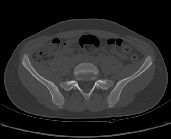 File:Aneurysmal bone cyst of ischium (Radiopaedia 25957-26094 Axial bone window 17).png