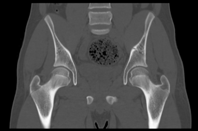 File:Aneurysmal bone cyst of ischium (Radiopaedia 25957-26094 Coronal bone window 21).png