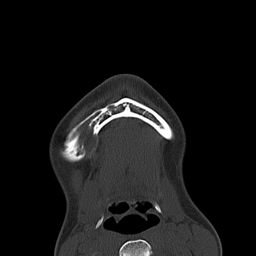 Aneurysmal bone cyst of the mandible (Radiopaedia 43280-46601 Axial bone window 4).jpg