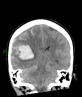 File:Aneurysmal subarachnoid hemorrhage with intra-axial extension (Radiopaedia 84371-99699 Coronal non-contrast 30).jpg