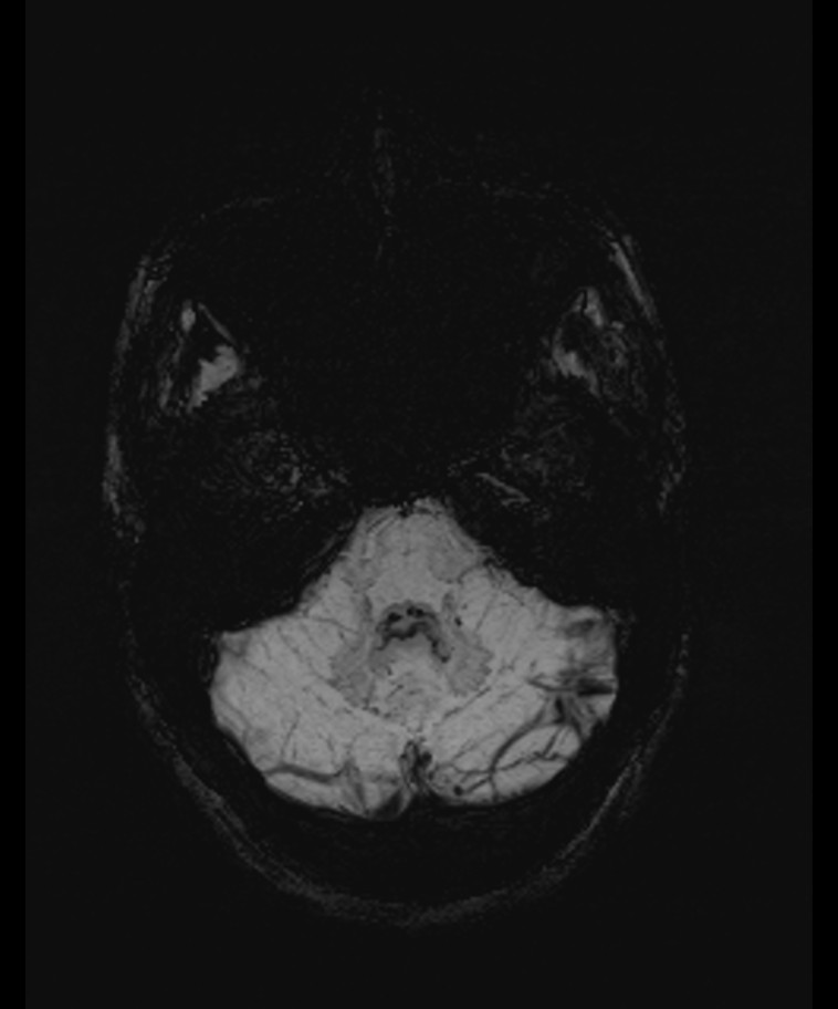Angiomatous meningioma (Radiopaedia 79459-92579 E 13).jpg