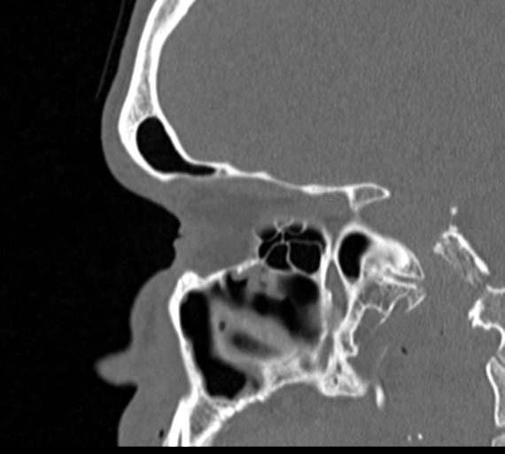 Angular epidermoid cyst (Radiopaedia 46908-51439 Sagittal bone window 28).png