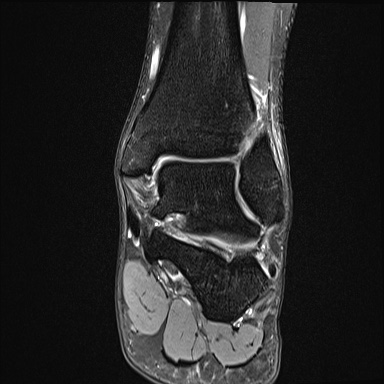 Ankle syndesmotic injury (Radiopaedia 69066-78837 Coronal PD fat sat 30).jpg