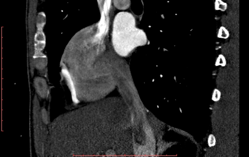 File:Anomalous left coronary artery from the pulmonary artery (ALCAPA) (Radiopaedia 70148-80181 C 37).jpg