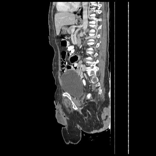 Anorectal carcinoma (Radiopaedia 44413-48064 C 62).jpg