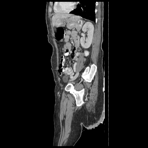 Anorectal carcinoma (Radiopaedia 44413-48064 C 74).jpg