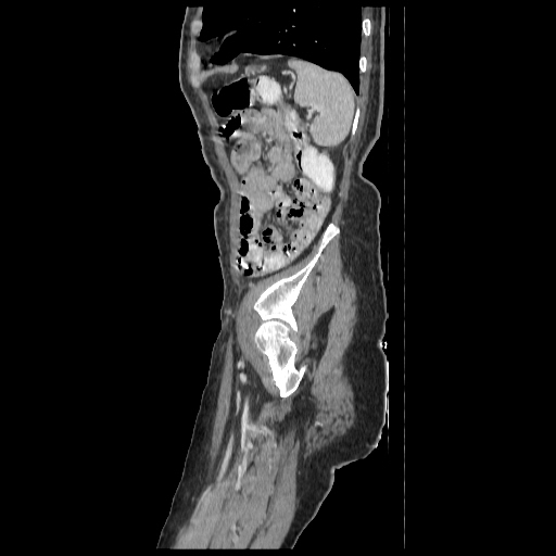 Anorectal carcinoma (Radiopaedia 44413-48064 C 93).jpg