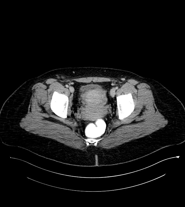 Anterior abdominal wall CSF pseudocyst (CSFoma) (Radiopaedia 79453-92571 A 83).jpg